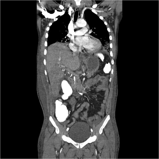 Coronal CT image with partially visible ERCP stent in the distal common bile duct with surrounding clip artifact.