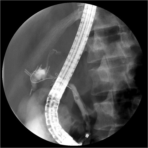 ERCP with contrast extravasation from distal common bile duct. Note several surgical clips adjacent to the injury.
