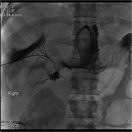 Percutaneous Transhepatic Cholangiogram with proximal contrast extravasation. Note adjacent surgical clips.