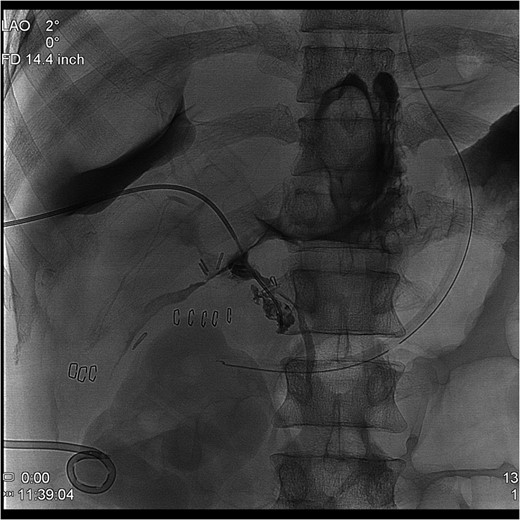 Percutaneous Transhepatic Cholangiogram showing contrast filling the distal duct following continued injection.
