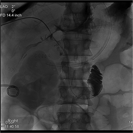 Percutaneous Transhepatic Cholangiogram with wire traversing into the distal common bile duct orifice. Note duodenum filling with contrast.