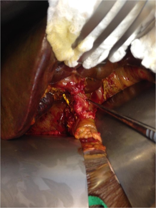 Intra-operative image of PTC catheter exiting the proximal hepatic duct injury and entering the distal common bile duct orifice. Forceps retracting proper hepatic artery.