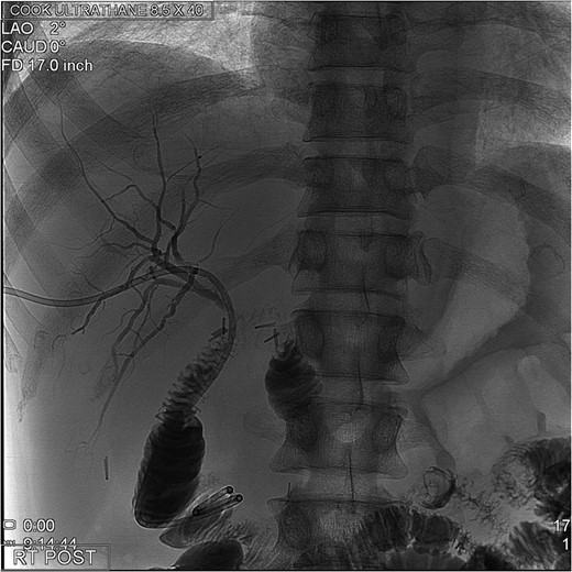 Final post-operative cholangiogram with normal intrahepatic ducts opacifying Roux-en-Y hepaticojejunostomy.