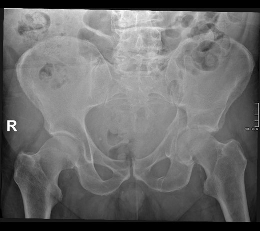 Plan film radiograph AP of pelvis.