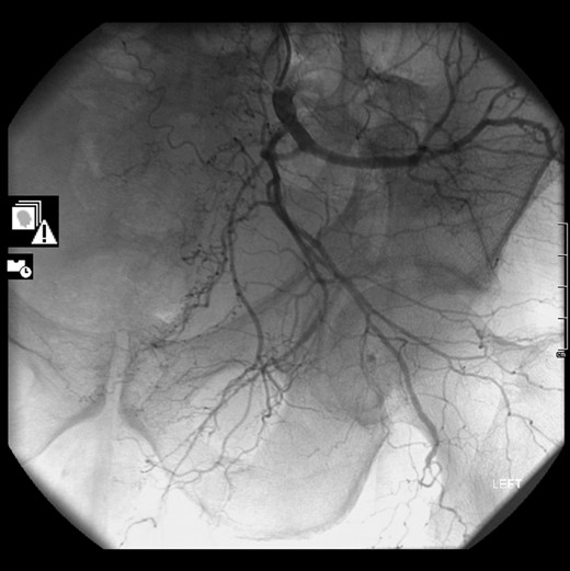 CT angiogram of internal iliac artery.