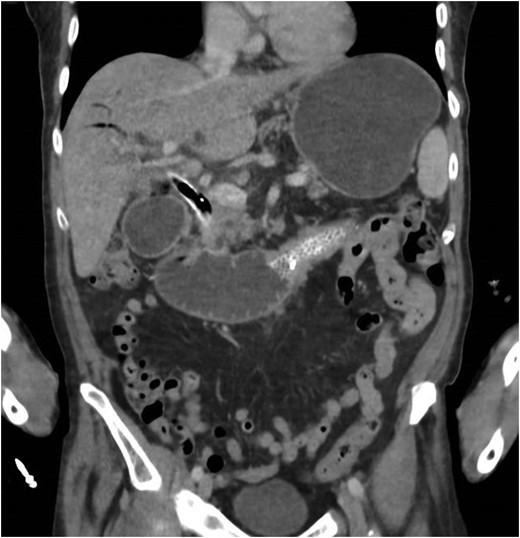CT scan showing gastric and duodenal dilatation down to the level of the stent suggesting obstruction at this level.