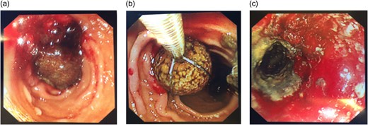 Gastroscopy showing the impacted stone (a), stone retrieval (b) and a patent lumen post procedure (c).