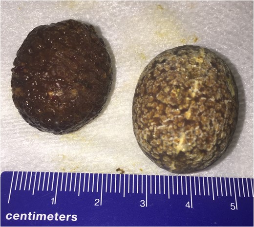Cholesterol stones causing duodenal stent obstruction.