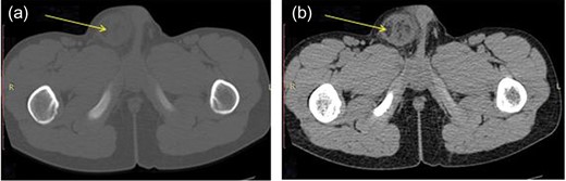 CT scan before (a) and after (b) intravenous contrast, showed an image of a greasy substance in the scrotum.