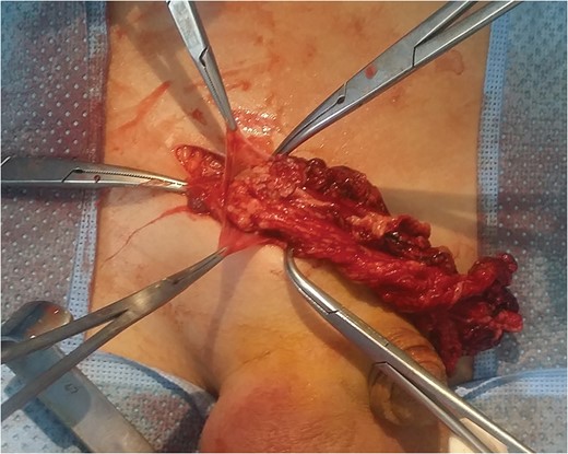 Omentum incarcerated in inguinal hernia with a segmental infarct.