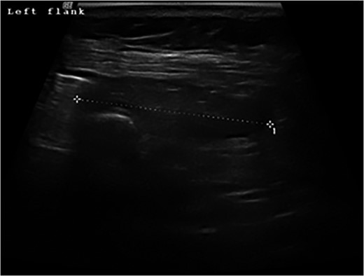 Ultrasound scan of the left flank showing possible hernia in a 72-year-old woman presenting with a flank swelling (dashed line).