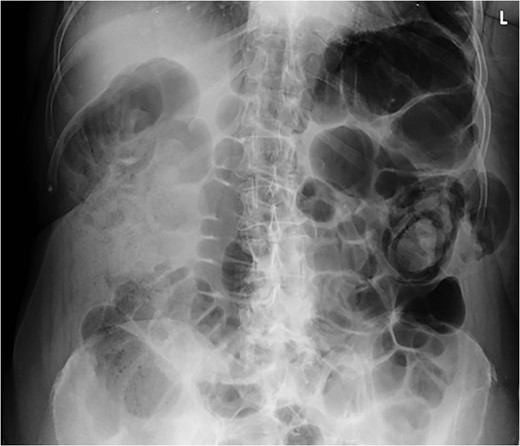 Abdominal supine plain radiograph showing faecal loading in ascending colon and dilated large bowel loops in a 72-year-old woman diagnosed with large bowel obstruction secondary to left sided superior lumbar triangle hernia.