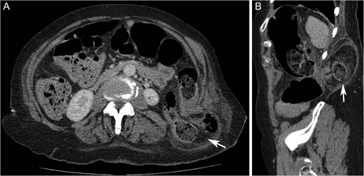 Computed tomography axial (A) and sagittal (B) images showing left sided superior lumbar triangle (Grynfeltt-Lesshaft) hernia containing loop of (‘arrows’) in a 72-year-old woman.