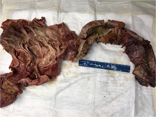 Gross examination reveals thickened wall with portion of lumen dilation.