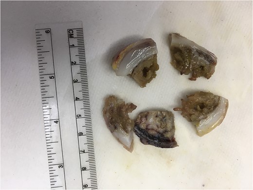 Gross examination reveals numerous polyps growing into the lumen.