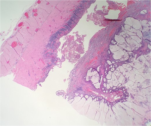 Microscopic examination reveals extensive hyperplastic changes with mucinous pool.