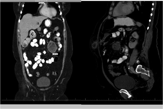 CT scans of the abdomen showing the mass.