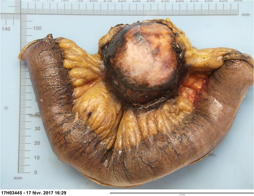 Macroscopic view of the resected tumor.