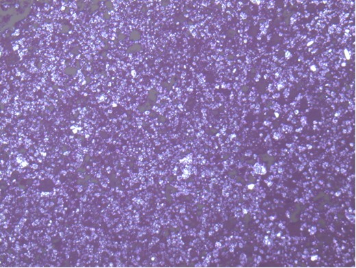 Microscopic appearance of chronic abscessing inflammation with large areas of pink necrotic tissue that are bordered by granulation tissue with numerous prominent capillaries filled with blood, foam cells and foreign body giant cells.