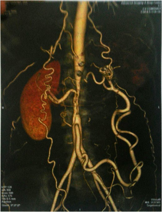 CT angiogram showing narrowing of abdominal aorta from origin of SMA up to IMA with multiple large collaterals, narrowed right renal artery and significantly narrowed left renal artery with poor enhancement of renal parenchyma.