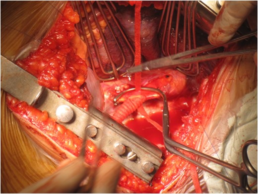 Anastomosis between descending thoracic aorta and polyester graft.