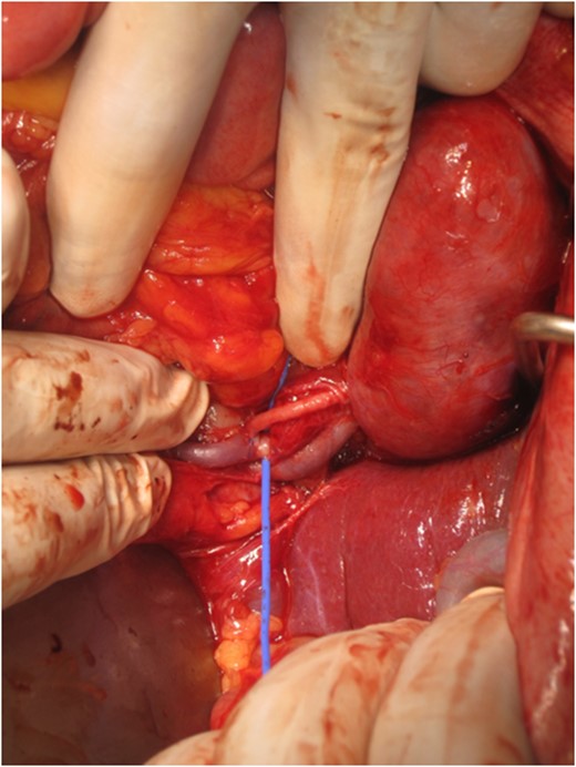 Following anastomosis between thoracic aorta and polyester graft an anastomosis was made between the graft and left common iliac artery (picture not provided). Reverse saphenous vein graft was harvested and anastomosed between the polyester and the right renal artery distal to the site of narrowing (shown in the provided picture).