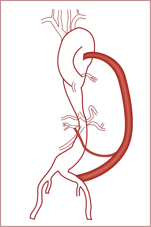 It is a pictorial representation of the entire operative procedure that we hope would give a clearer picture. It shows the graft between the descending thoracic aorta and left common iliac artery and reverse saphenous vein graft between the polyester graft and right renal artery.