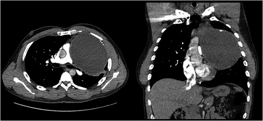 Computed tomography of the mediastinal mass. Transverse cross sectional view. The cystic mass is compressing the pulmonary trunk and the left main bronchus.