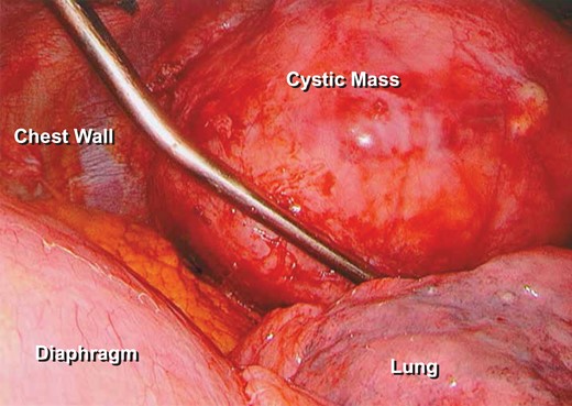 Thoracoscopic video-assisted photograph of the thymic cyst. Demonstrates mass abutting the left lung. The pericardial fat is inferior to the mass in this picture.