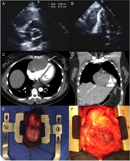 (A and B) Two-dimensional echocardiography. An apical two-chamber view reveals a well-circumscribed, oval hypoechoic mass with maximal diameter of 67 mm. (C and D) Axial and coronal CTA imaging of the tumor showing the direct contact and compression effect to the right ventricle. (E)—Intraoperative pictures demonstrating a large tumor adherent to the right ventricle. (F) The heart after removing of the tumor: almost entire anterior surface of the right ventricle has been involved. LV, left ventricle; RV, right ventricle; CTA, computer tomographic angiography.