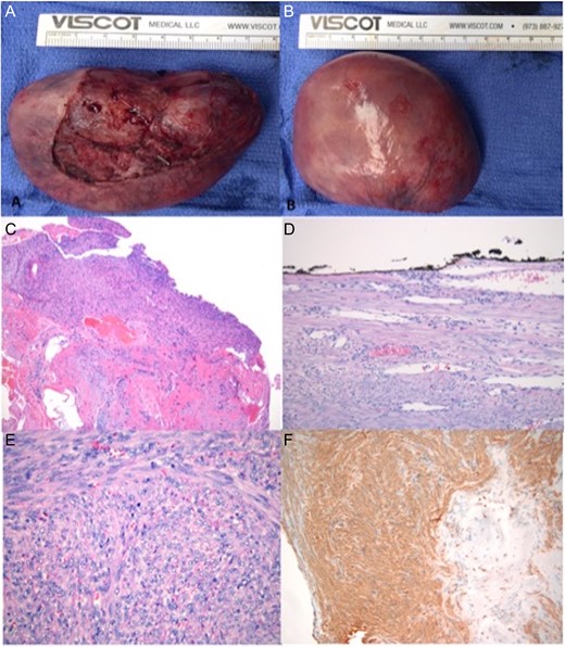(A and B) Itraoperatively obtained specimen. (C) Myocardial biopsy with ER/PR positive smooth muscle neoplasm composed of intersecting bundles of spindle cells, most resembling leiomyoma of deep soft tissue. Cardiac tissue and perivascular areas of myocardial interstitium adjacent to the tumor were involved. (D) No atypia or necrosis seen. Well circumscribed, mitotically active, and focally abutting the resection margin (inked black). (E) H&E staining of myocardial tumor showing mitotic figures in the tumor. (F) Immunohistochemistry staining positive for SMA.
