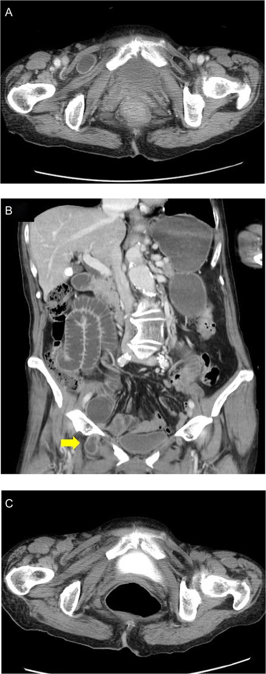 (A) Incarcerated obturator hernia on the right side was confirmed by CT image. Bowel wall of the incarcerated intestine showed contrast enhancement without findings of irreversible ischaemic change or perforation. (B) Coronal plane of CT image, before reduction. The oral side intestine was markedly distended and contrast enhanced. (C) Reduction of the incarcerated intestine was confirmed by CT image.