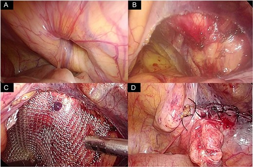 Repair of the right side obturator hernia. (A) Obturator hernia on the right side was confirmed. (B) The peritoneum on the Cooper ligament was cut and the preperitoneal space around the obturator foramen was dissected. (C) A prosthetic mesh (6 × 7 cm in size) was inserted in the dissected space and the mesh was tacked onto the Cooper ligament. The obturator foramen was covered by the mesh maintain a 2–3 cm margin. (D) The peritoneum was closed with sutures.