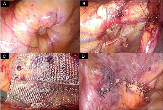 Repair of the left side obturator hernia. (A) Obturator hernia on the left side was detected during laparoscopy. (B) The peritoneum on the Cooper ligament was cut and the preperitoneal space around the obturator foramen was dissected. (C) A prosthetic mesh (6 × 6 cm in size) was inserted in the dissected space and the mesh was tacked onto the Cooper ligament. The obturator foramen was covered by the mesh maintaining a 2–3 cm margin. (D) The peritoneum was closed with sutures.