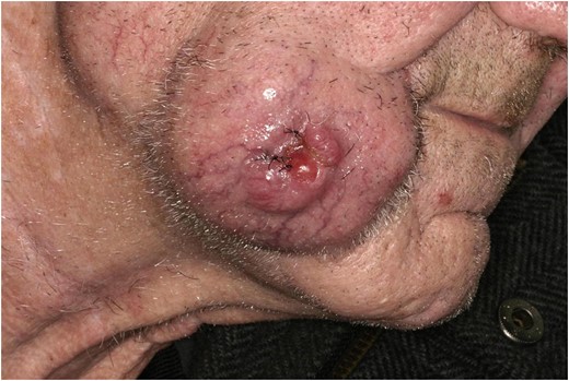 Image showing the indurated, exophytic tumour following incisional biopsy. Source: Royal Albert Edward Infirmary.