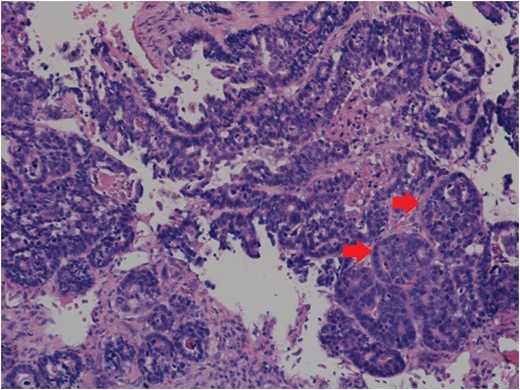 Histology showing paraspinal tissue replaced and permeated by metastatic adenocarcinoma with large areas of necrosis. Arrows point to clusters of tumour cells. Source: Salford Royal Hospital Histology Department.