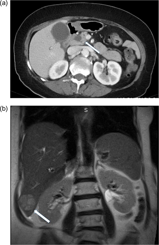 (a) CT scan of the abdomen showing pancreatic mass, solid arrow. (b) MRI of the abdomen showing segment six hepatic lesion, solid arrow.