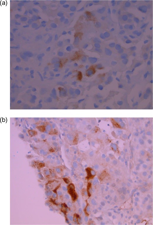 Tumor cells in cell block (FNA specimen) are positive for hepatocyte specific antigen (a) and alphafetoprotein (b) (magnification ×40).