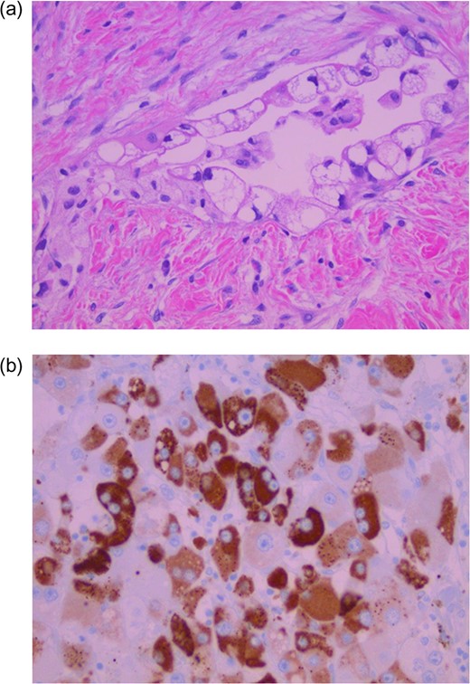 Adenocarcinoma with foamy cytoplasm invading dense stromal tissue (a). Tumor cells are positive for hepatocyte specific antigen (b) (magnification ×40).