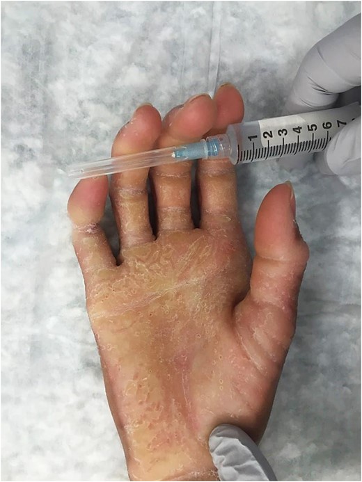 Preoperative. Right hand (volar) showing palmar and digital hyperkeratotic scales and circumferential constriction band on right small finger around proximal interphalangeal joint.