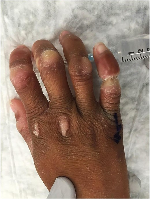 Preoperative. Right hand (dorsal) showing hyperkeratotic scales on metacarpal phalangeal and proximal interphalangeal joints of first three digits and circumferential constriction band on right small finger around proximal interphalangeal joint.