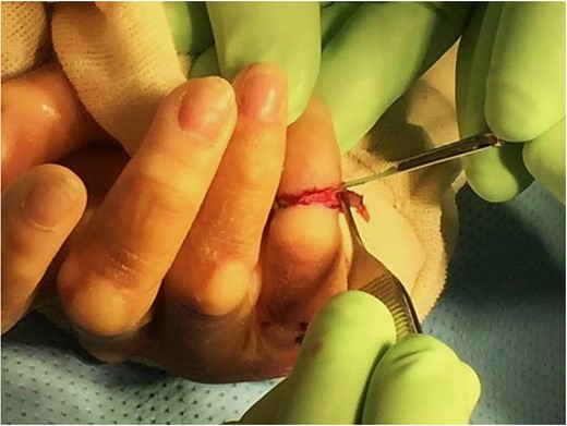 Surgical scalpel blade No. 15 was used to incise and elevate the constriction band circumferentially, taking care not to dissect too deeply to avoid injury to digital nerve and vessels.