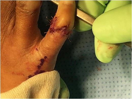 Six Z-plasty transposition flaps incorporated for primary closure after constriction band release.