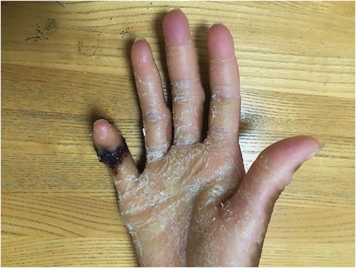 Two weeks postoperative. Z-plasty incisions are well-approximated with scabs of crusted blood. Recurrence of hyperkeratotic scales disseminated on right volar hand.