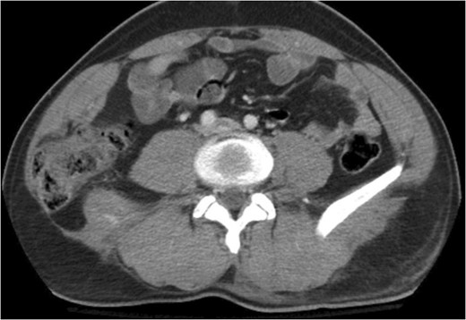 The traumatic lumbar hernia is seen on the right side of the abdominal wall above the iliac crest on computed tomography.
