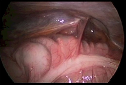 With the patient in the left lateral decubitus the herniated right colon spontaneously reduces and the hernia is demonstrated.