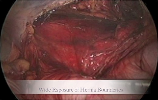 Step 1 begins with incision of the peritoneum overlying the hernia.