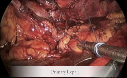 Step 2, primary repair of the hernia.