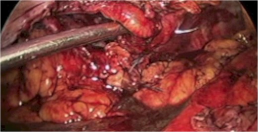 Autologous tissue is used for the primary repair.