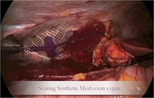 Seating of the synthetic mesh underlay.